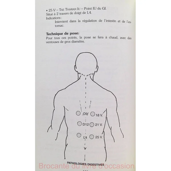 La médecine des ventouses